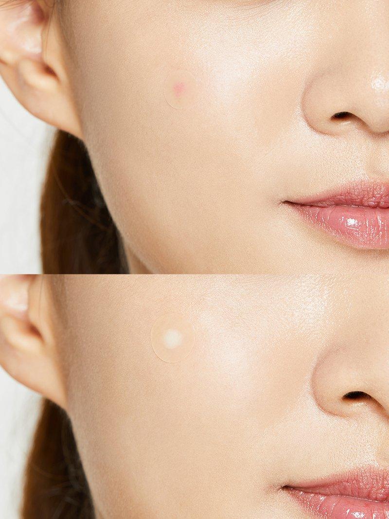 COSRX – Acne Pimple Master Patch — Cura rápido, sin tocar ni dejar marca